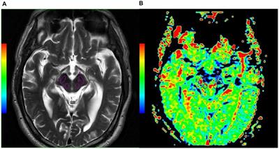 Changes of Amide Proton Transfer Imaging in Multiple System Atrophy Parkinsonism Type